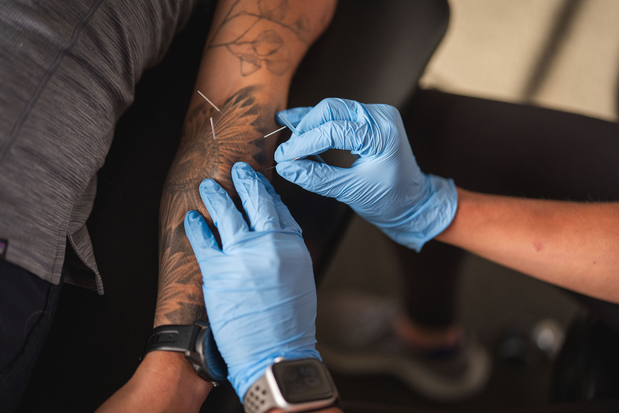 Physical therapist performing dry needling on patient's shoulder