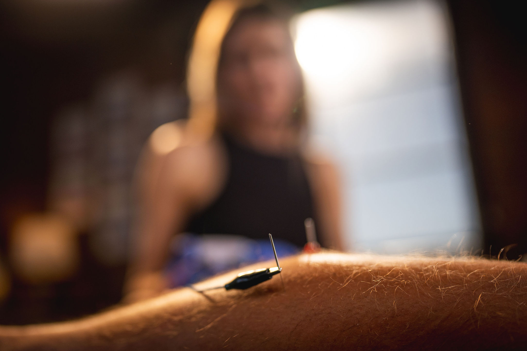 Thumbnail of Patient receiving therapeutic dry needling treatment